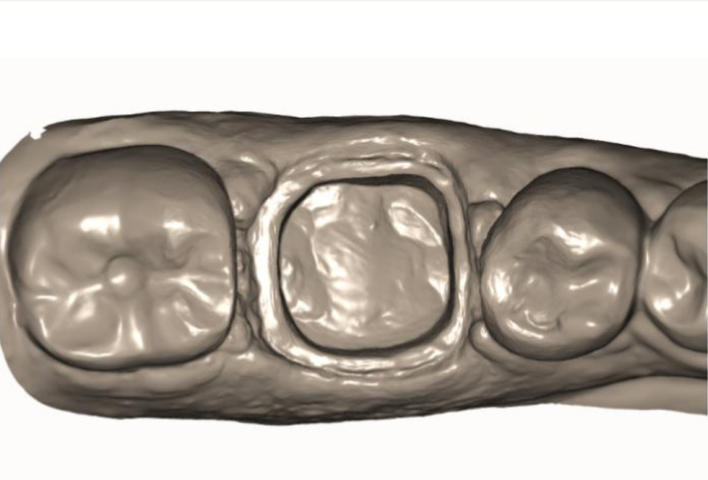 Scan of margin taken with a double cord technique