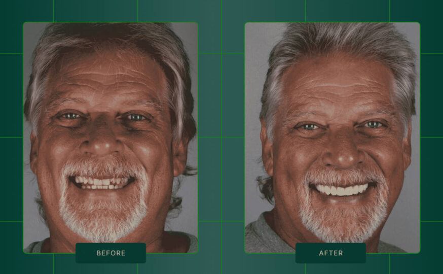 Case Study: 10-Unit Zirconia Smile Transformation