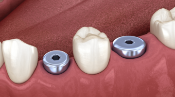 3D imagery of an implant healing abutment