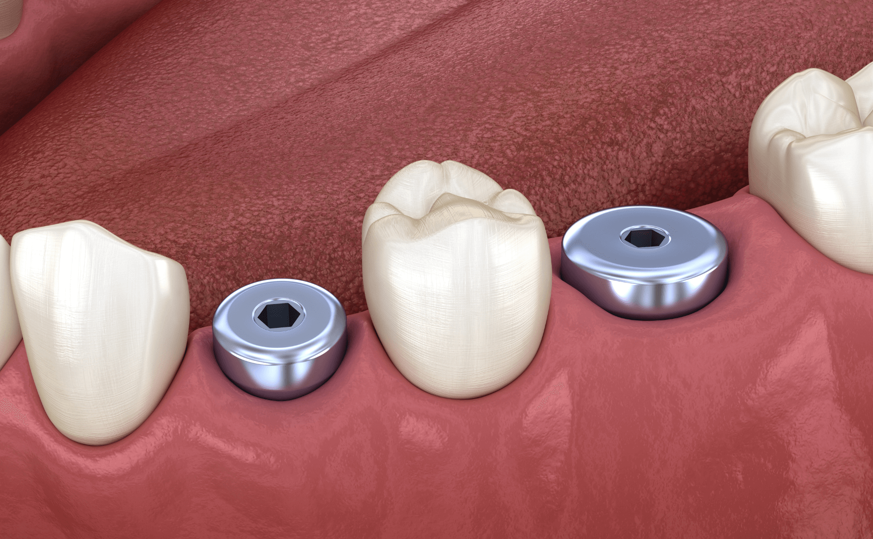 Healing Abutments vs Cover Screw: A comparative guide | Dandy