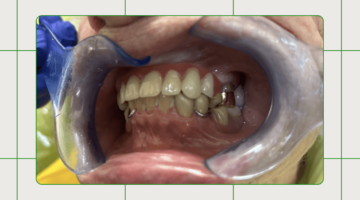 Case Study: Restoring the anterior zone with maxillary partials