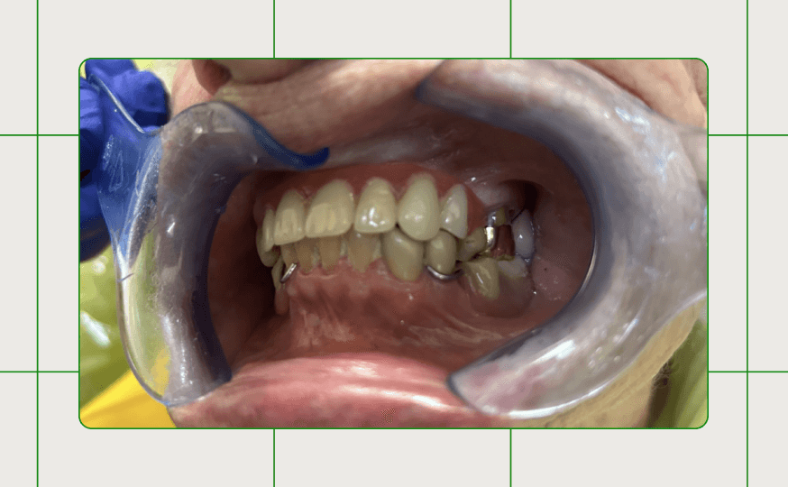 Case Study: Restoring the anterior zone with maxillary partials