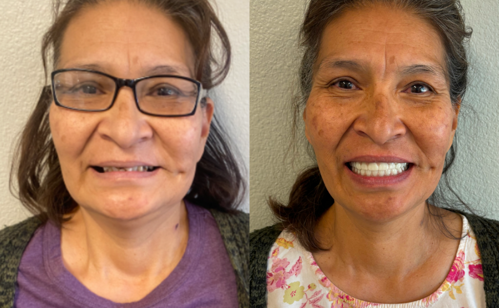 Case Study: A Fully Restored Smile - From Immediate to Implant-Supported Dentures