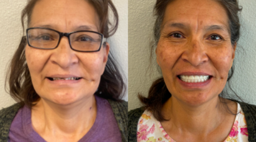 Case Study: A Fully Restored Smile - From Immediate to Implant-Supported Dentures