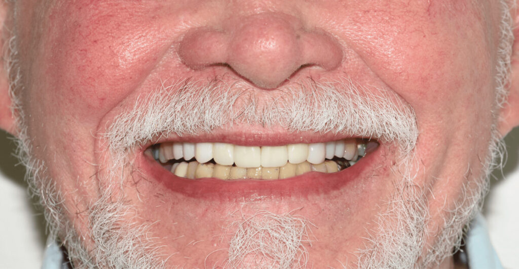 Figure 4: The delivered veneers, crowns, and implant-bridge. Note the aesthetic quality and unison this creates for the patient’s smile.