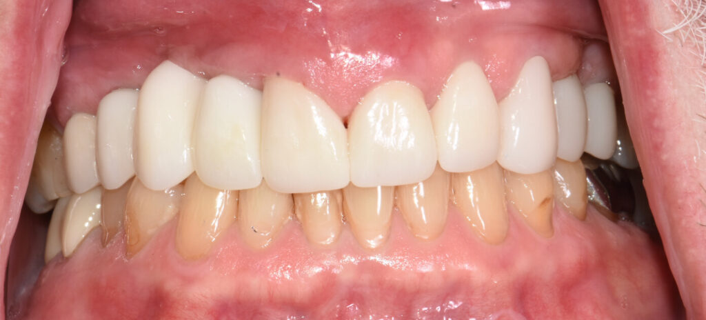 The delivered veneers, crowns, and implant-bridge